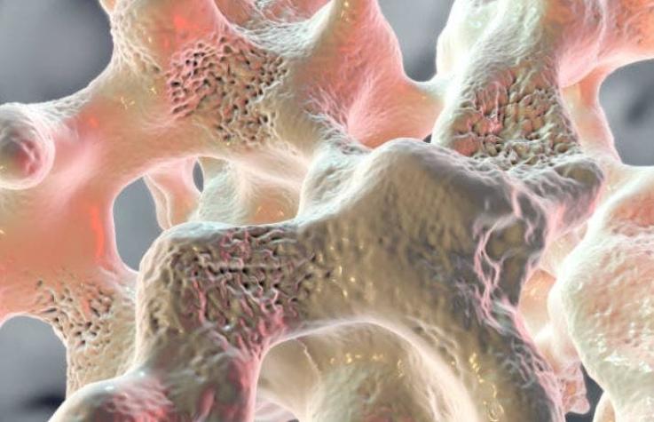 El nuevo y revolucionario tratamiento contra la osteoporosis que promete "regenerar" huesos