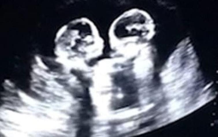 [VIDEO] Gemelas son sorprendidas "peleando" en el útero de su madre durante una ecografía