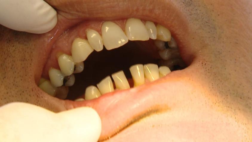 [VIDEO] Reportajes T13 : Las dificultades de la salud pública que impiden ver un especialista dental