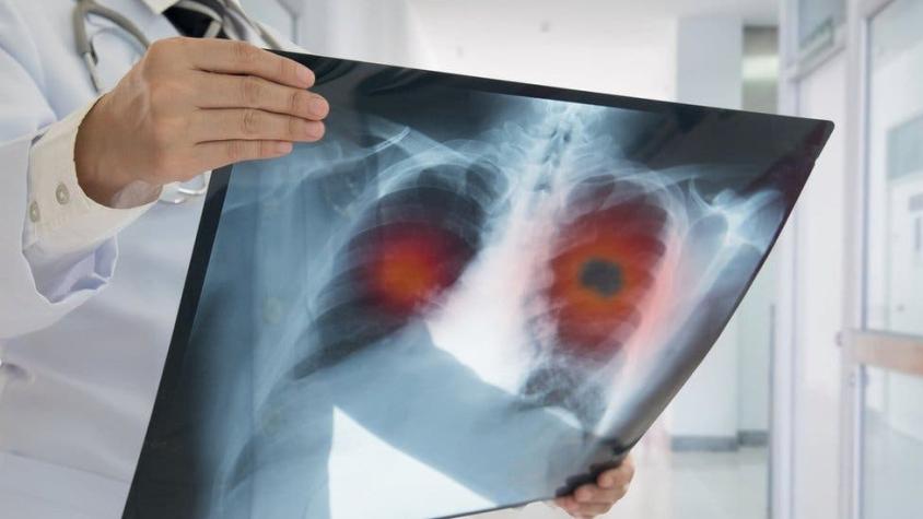 El programa de Google que detecta cáncer de pulmón "con más eficiencia que los médicos"