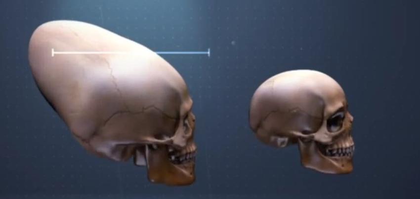[VIDEO] El misterio que rodea a los cráneos alargados que se encontraron en Arica