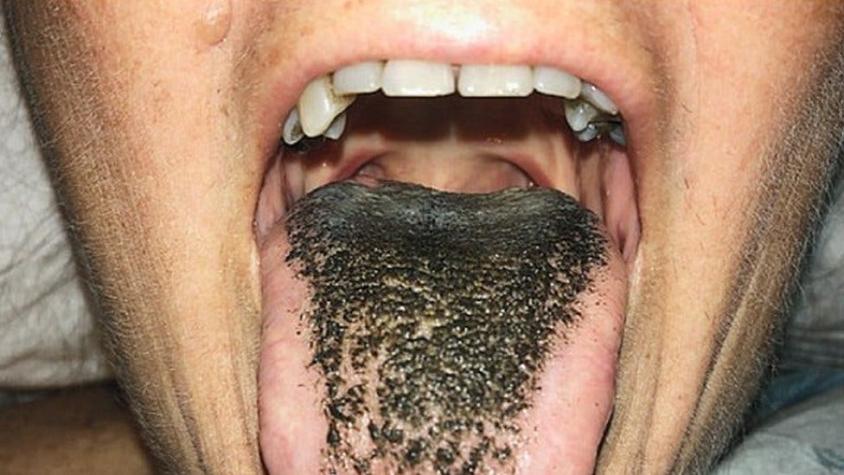 Qué es el extraño trastorno médico de la lengua "peluda"