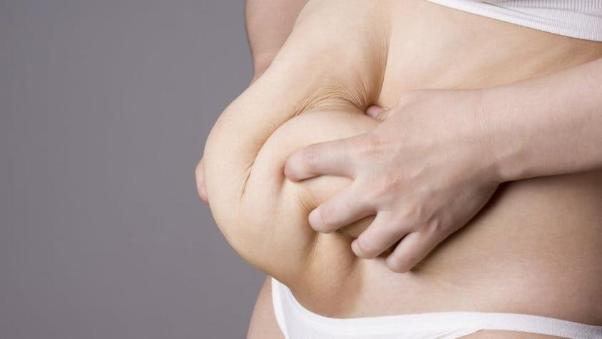 Mujer recauda dinero en internet para quitarse de encima 7 kg de piel que le sobran tras perder peso