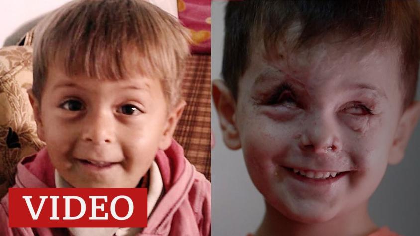 Siria: la devastadora historia del niño de 4 años cuyo rostro fue desfigurado por un ataque aéreo