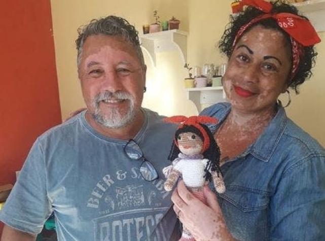 [FOTOS] Un hombre con vitiligo teje muñecos para niños con la misma condición