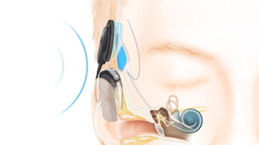 [VIDEO] Implante coclear: "el milagro de escuchar"