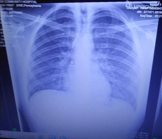 El terrible estado de los pulmones de joven de 19 años que vapea: Tienen  aceite solidificado