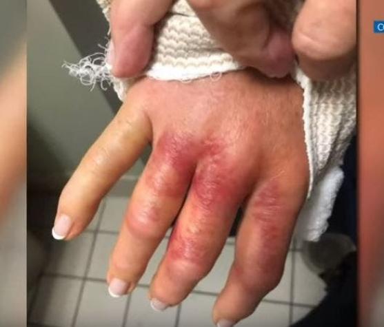 Mujer casi pierde su mano tras hacerse la manicure: Se infectó con bacteria carnívora