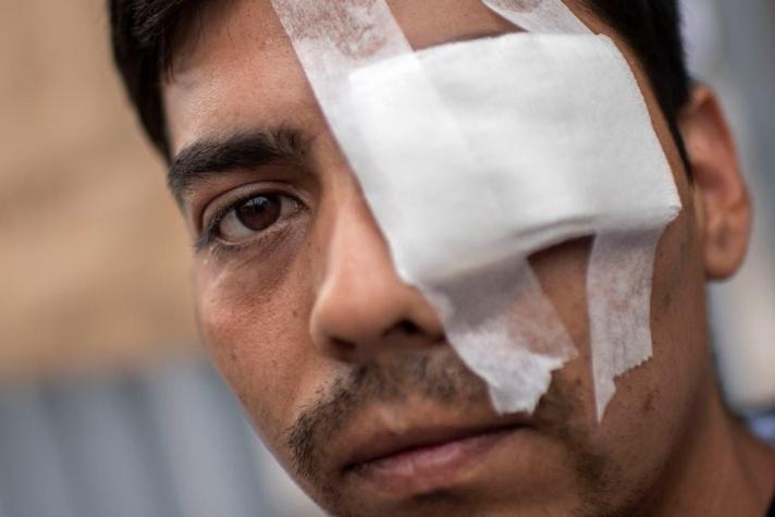 Sociedad Chilena de Oftalmología habla de "emergencia sanitaria" por casos de lesiones oculares