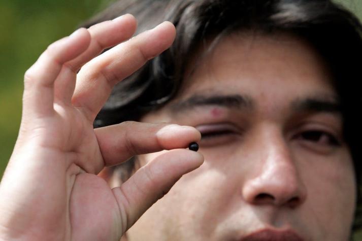 Minsal lanza programa de reparación ocular en medio de récord de heridos por perdigones policiales