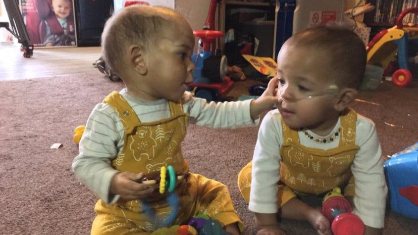 Bebé prematuro gravemente enfermo mejoró en la incubadora luego del abrazo de su hermano gemelo