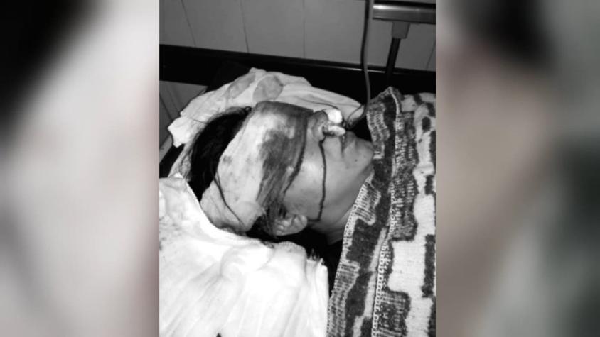 Mujer quedó con ceguera total tras recibir lacrimógena: INDH anuncia querella contra Carabineros