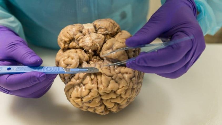 Cómo se pueden donar pedazos de cerebro a la ciencia antes de morir