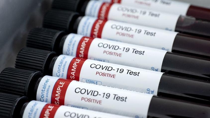 Coronavirus: la nueva prueba de anticuerpos que es "crucial" para hacer frente a la pandemia