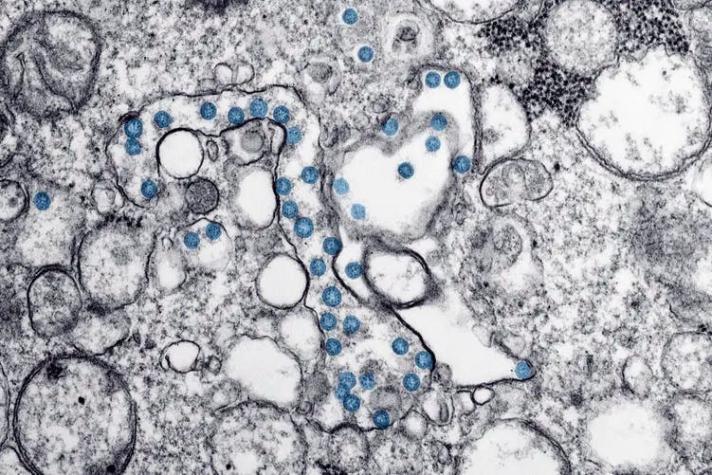 La "misteriosa" proliferación de trombos en los enfermos de COVID-19