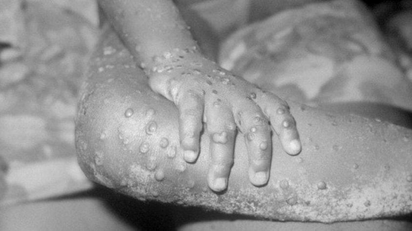 Coronavirus: la viruela, las lecciones que dejó la única enfermedad humana que ha sido erradica