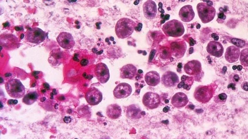 Ameba "come cerebros": autoridades de Florida emiten alerta de salud tras un raro caso de infección