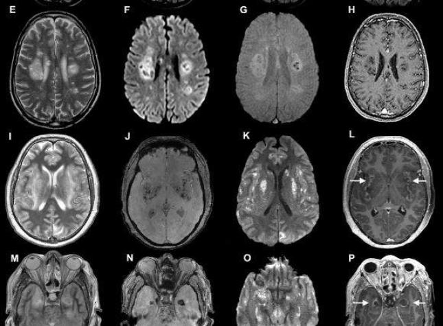 ¿Cómo el COVID-19 ataca al cerebro?: "Si se infecta, podría tener una consecuencia fatal"