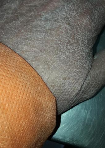 Coronavirus: Enfermera comparte dramática imagen de sus manos al quitarse los guantes