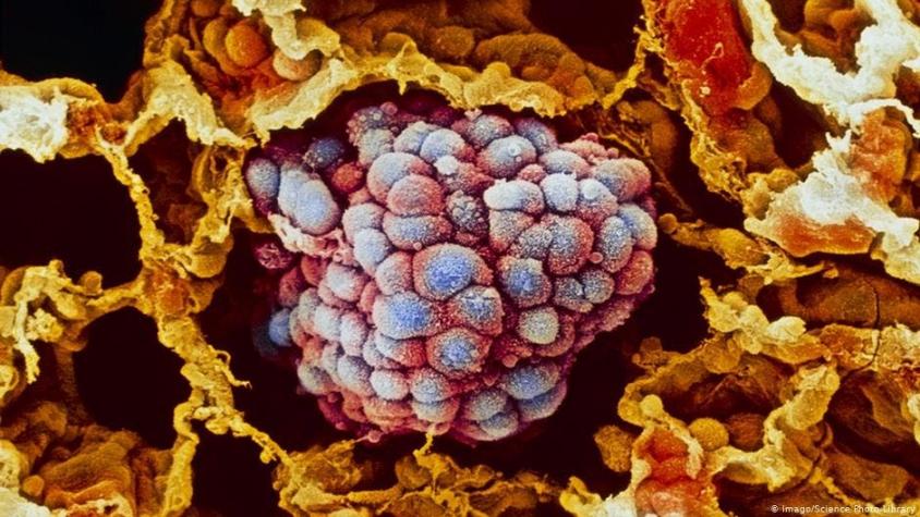 Vacuna experimental contra el cáncer podría inhibir el crecimiento de tumores