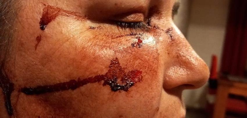 Mujer sufre brutal golpiza lesbofóbica en Lampa: le patearon la cabeza y la trataron de "sucia"