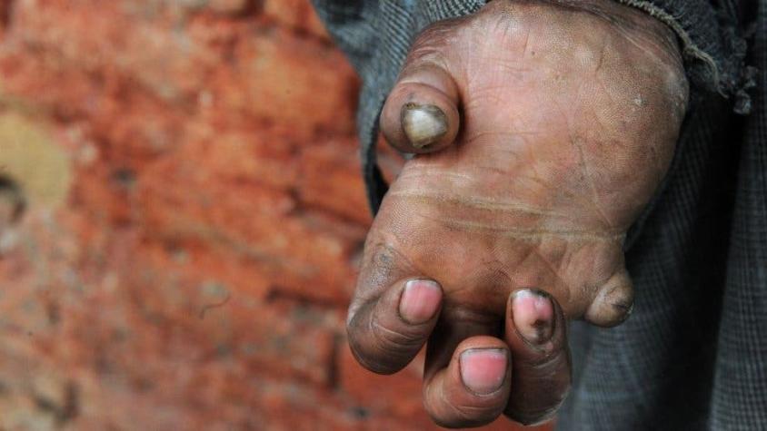 En qué países sigue habiendo lepra (y por qué no se ha logrado erradicar)