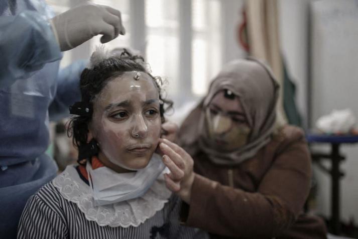 [FOTOS] Crean máscaras impresas en 3D para curar rostros de quemados en Gaza