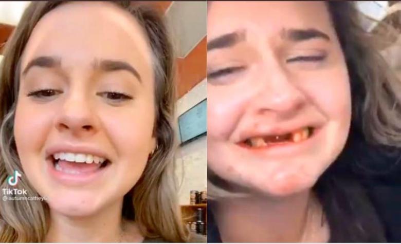 Tiktoker pierde sus dientes delanteros por grabar un video