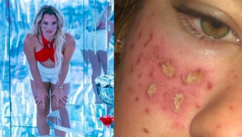 [FOTOS] Joven australiana se quema la cara probando un truco de Tiktok para tener pecas