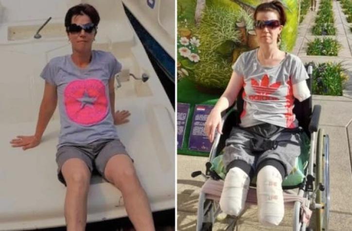 Una mujer fue al hospital por un dolor de estómago y le amputaron ambas piernas y un brazo