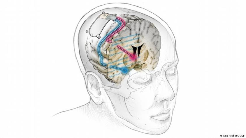 Primer implante cerebral del mundo trata con éxito depresión severa de un paciente