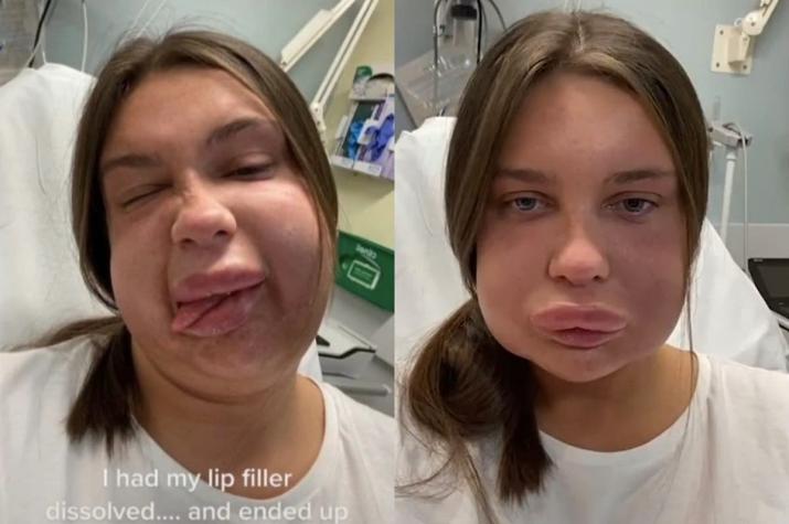 TikToker que disolvió su relleno de labios terminó en el hospital: la compararon con Homero Simpson