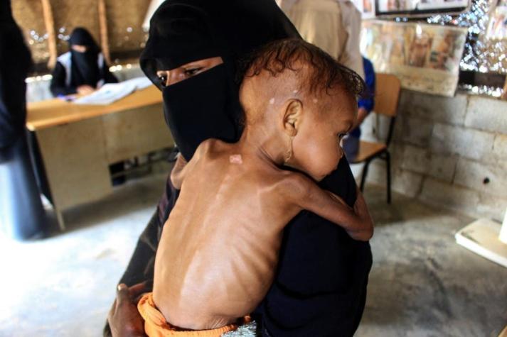 El terrible caso de Randa: La niña de Yemen que a los 3 años solo pesa 4 kilos