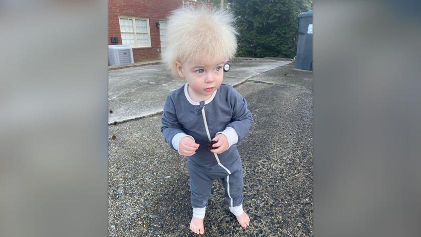 Niño de un año padece extraño síndrome que impide peinar su pelo: solo hay 100 casos en el mundo