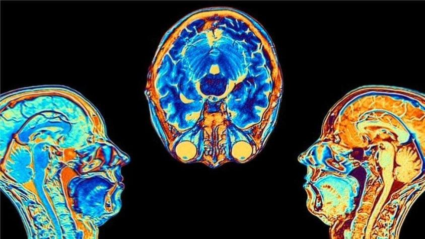 Covid: el estudio que muestra cómo cambia el cerebro tras una infección por coronavirus