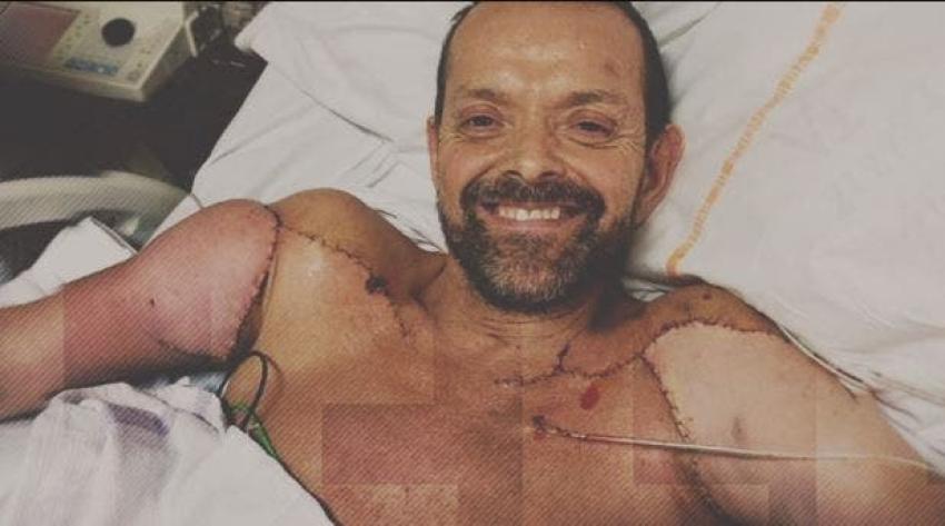 [VIDEO] Milagrosa recuperación: Hombre se sometió al primer doble trasplante de brazos