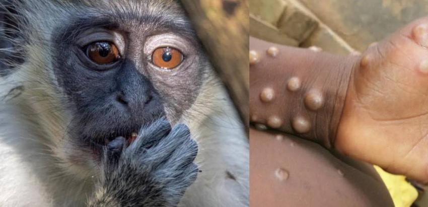 Argentina confirma el primer caso de viruela de mono