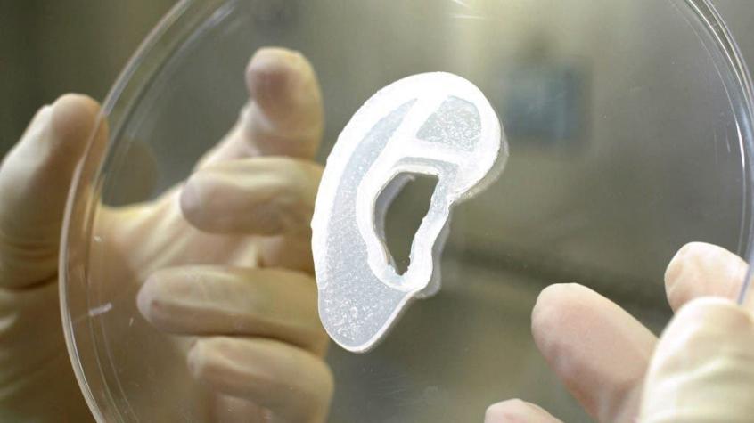 Implantan por primera vez a un humano una oreja creada con impresión 3D