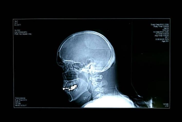 Hombre fue al hospital por un accidente en moto: Descubrieron que tenía una bala en la cabeza