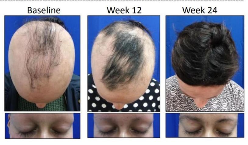 Pastilla contra la alopecia podría recuperar el 80% del cabello caído en seis meses