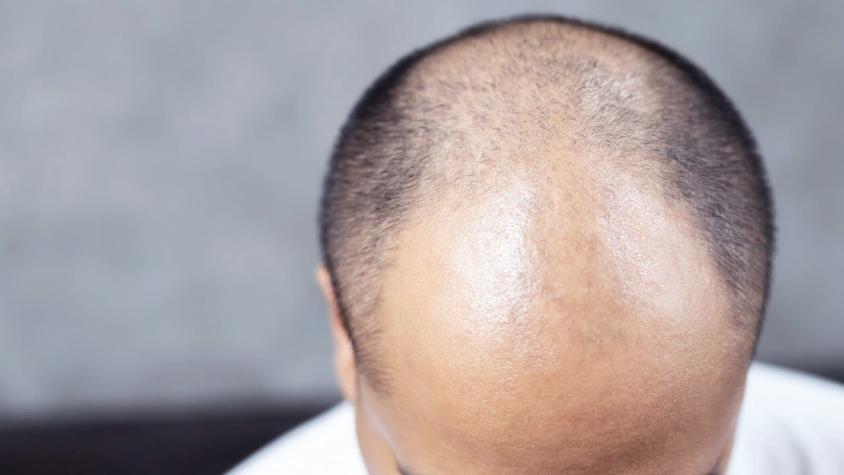 Aprueban primera píldora para el tratamiento de la alopecia en Estados Unidos