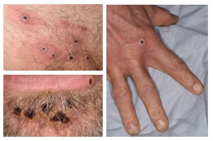 OMS asegura que la viruela del mono, por ahora, no una emergencia sanitaria