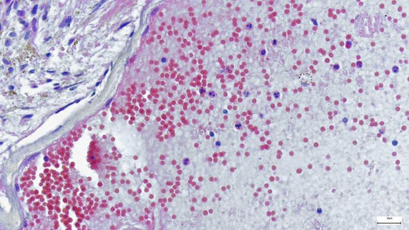 Viruela del mono en Chile: Cuántos casos van, cuáles son los síntomas y cómo se diagnostica