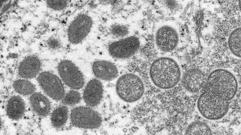 Viruela del mono: cuál es el perfil de infectados y cómo puede cambiar según avanza la enfermedad