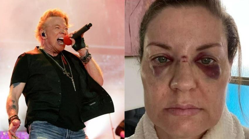 “Podría haberme matado”: Fan de Guns N’ Roses fue golpeada por micrófono lanzado por Axl Rose
