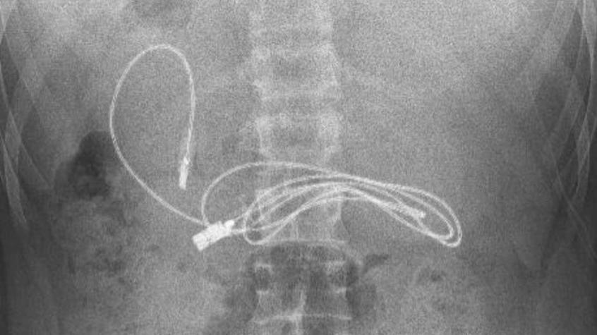 Encuentran cable USB en el estómago de un joven de 15 años