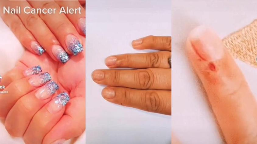Mujer es diagnosticada con cáncer en la uña tras hacerse la manicure en un salón