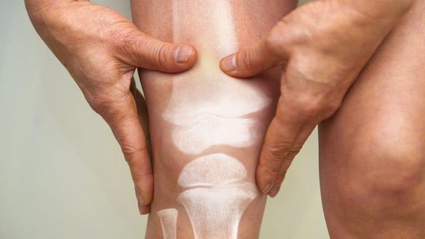 Osteoporosis masculina: la enfermedad silenciosa que cada año causa fracturas a miles de hombres