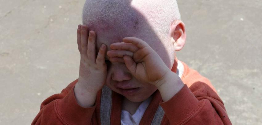 Son perseguidos para "rituales mágicos": Niño albino fue decapitado en RD Congo