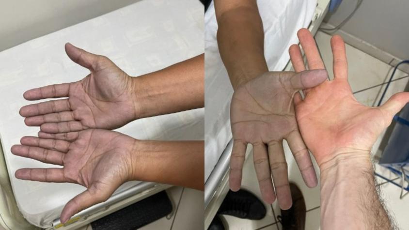 Hombre fue al médico porque tenía las "manos azules" y recibió insólito diagnóstico